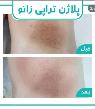 پلاژن تراپی زانو