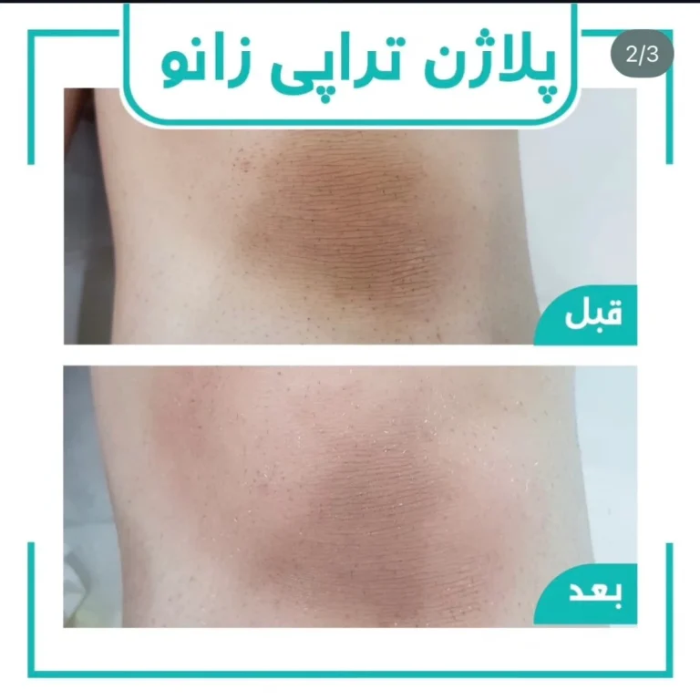 پلاژن تراپی زانو