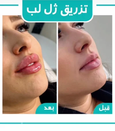 تزریق ژل لب