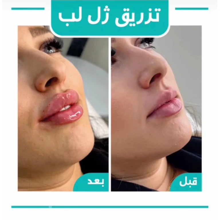 تزریق ژل لب
