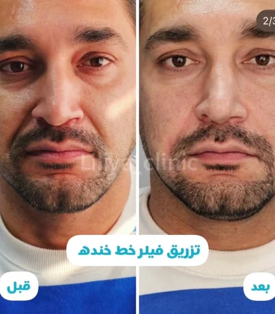 رفع خط خنده
