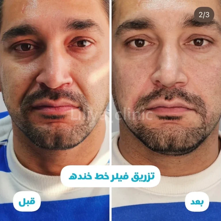 رفع خط خنده