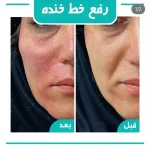 رفع خط خنده