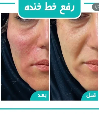 رفع خط خنده