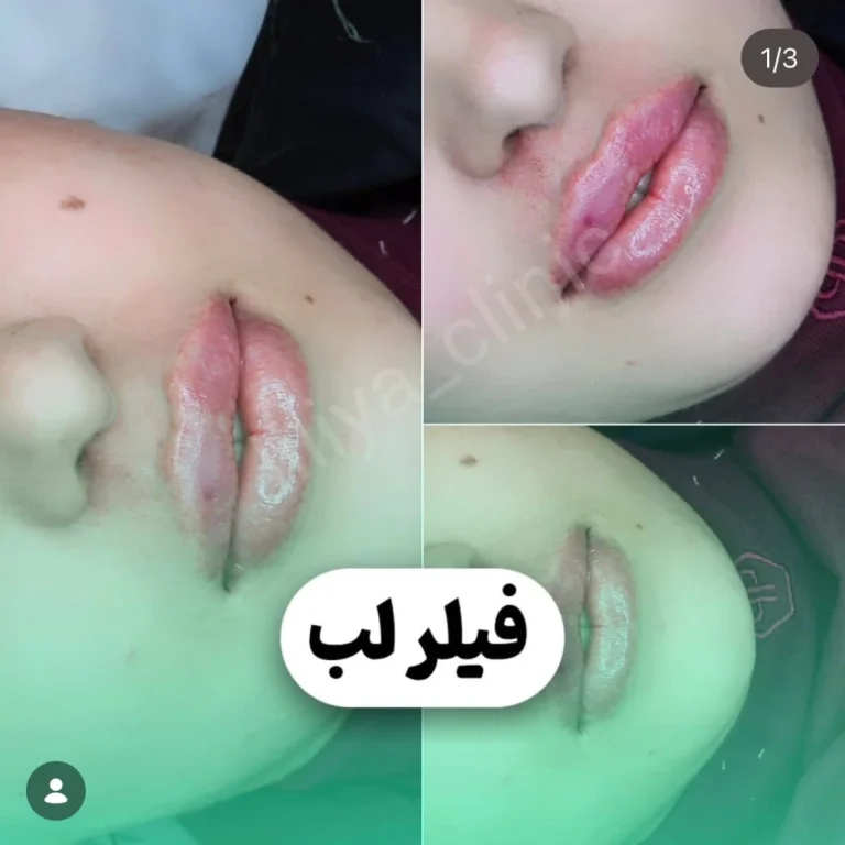 تزریق فیلر لب