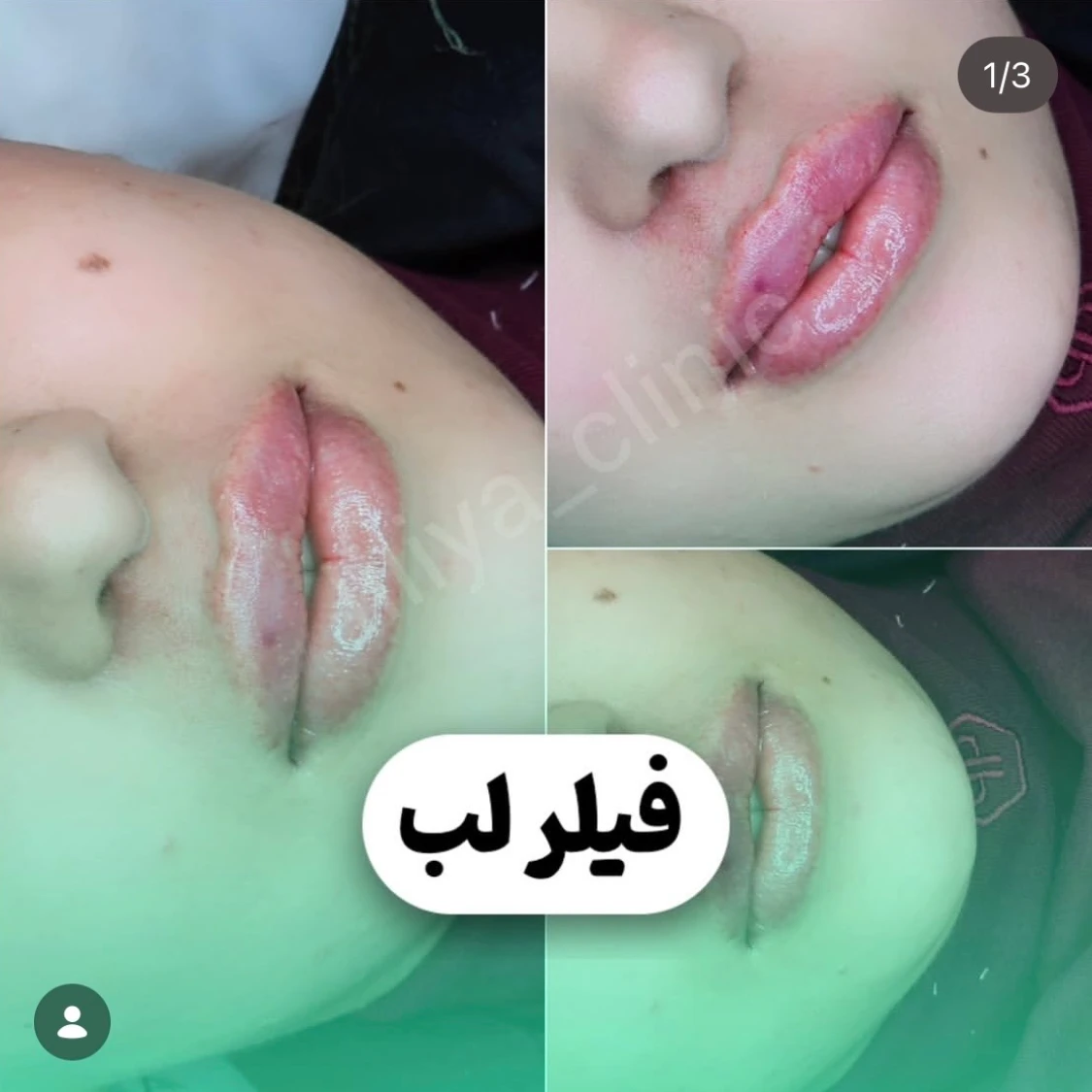 21 تزریق فیلر لب