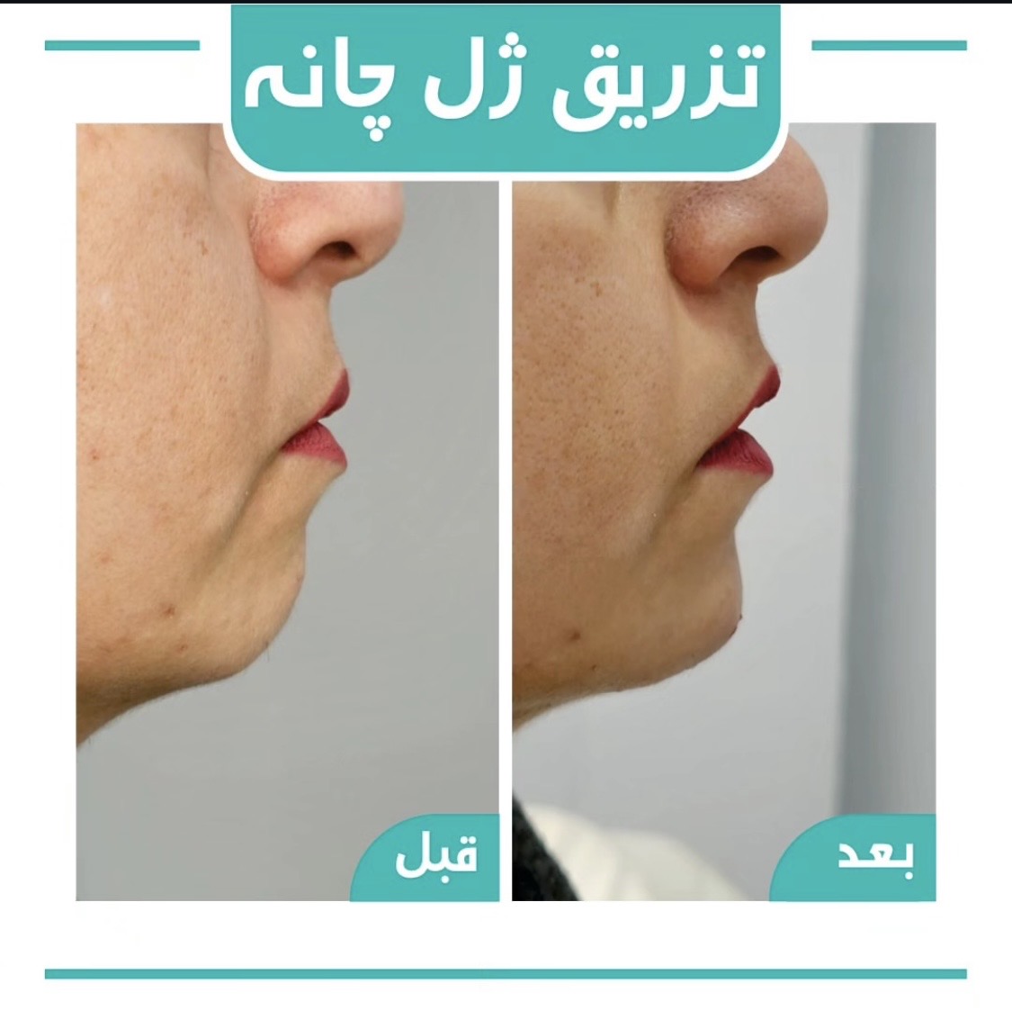 Screenshot تزریق فیلر چانه در کلینیک لیلیا - Image 1