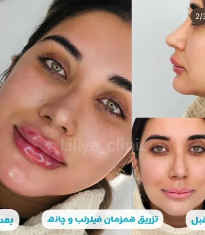 تزریق فیلر لب