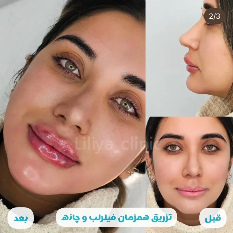 تزریق فیلر لب
