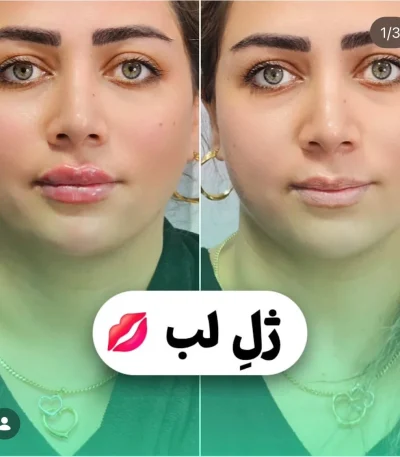 تزریق ژل لب