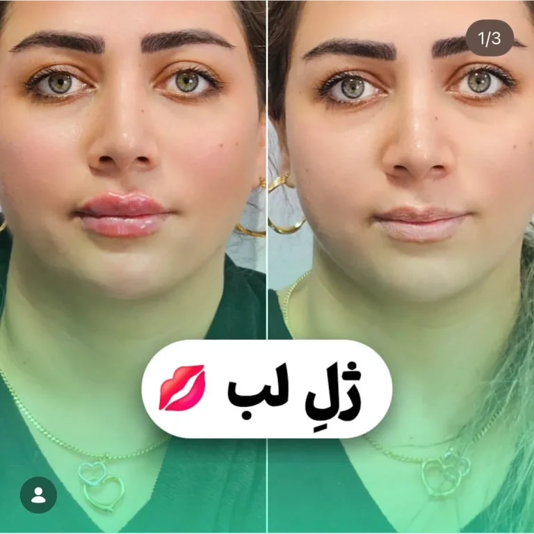 تزریق ژل لب