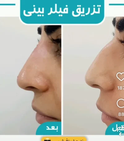 تزریق فیلر بینی