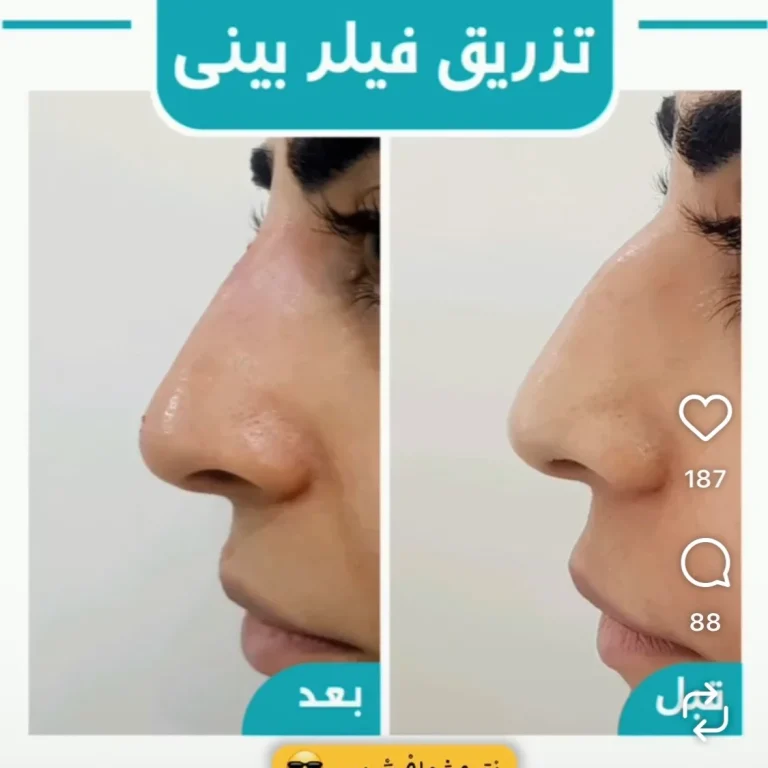 تزریق فیلر بینی