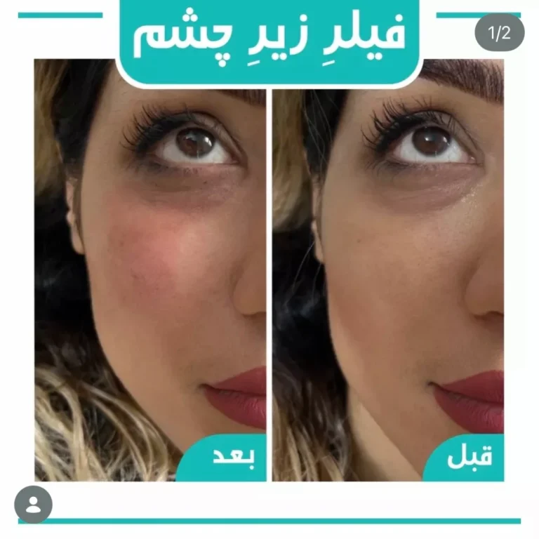 تزریق فیلر زیرچشم
